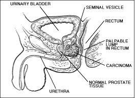 Picture of Prostate Gland Surrounded by Urinary Bladder and Uretha